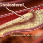 Cholesterol cao